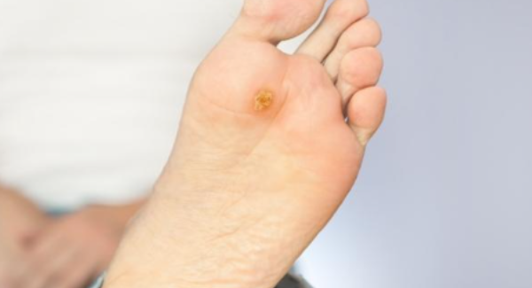 Launch of the Chronic Wound Consumables Scheme (CWCS)